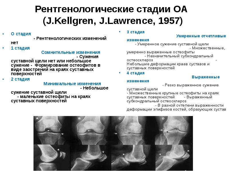 Рентгенологическая картина остеоартроза