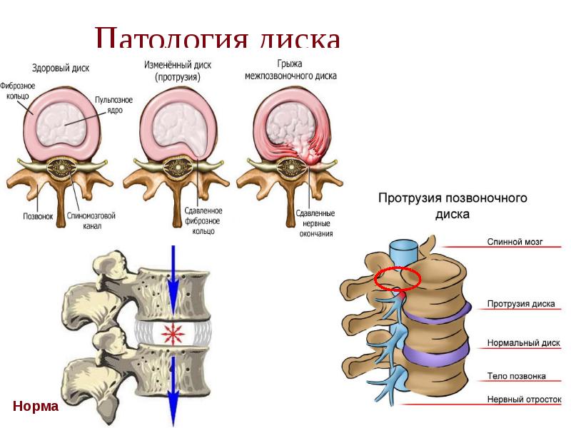 Патология диска