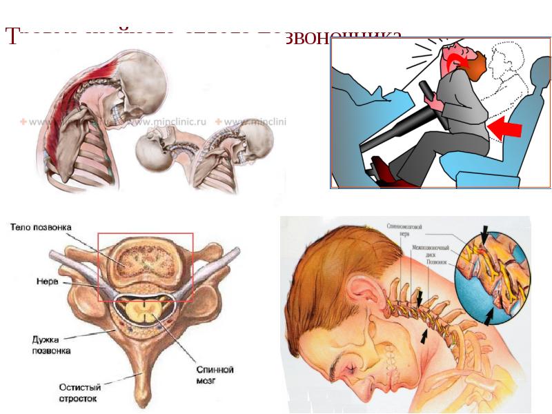 Травма шейного отдела позвоночника