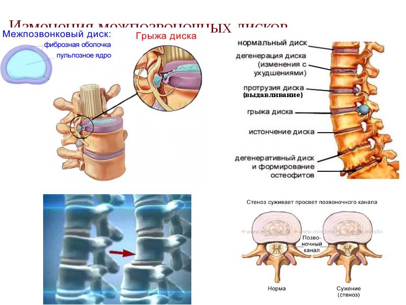 Изменения межпозвоночных дисков