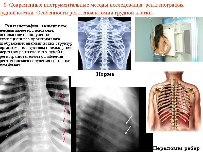 6. Современные инструментальные методы исследования: рентгенография грудной клетки. Особенности рентгеноанатомии грудной