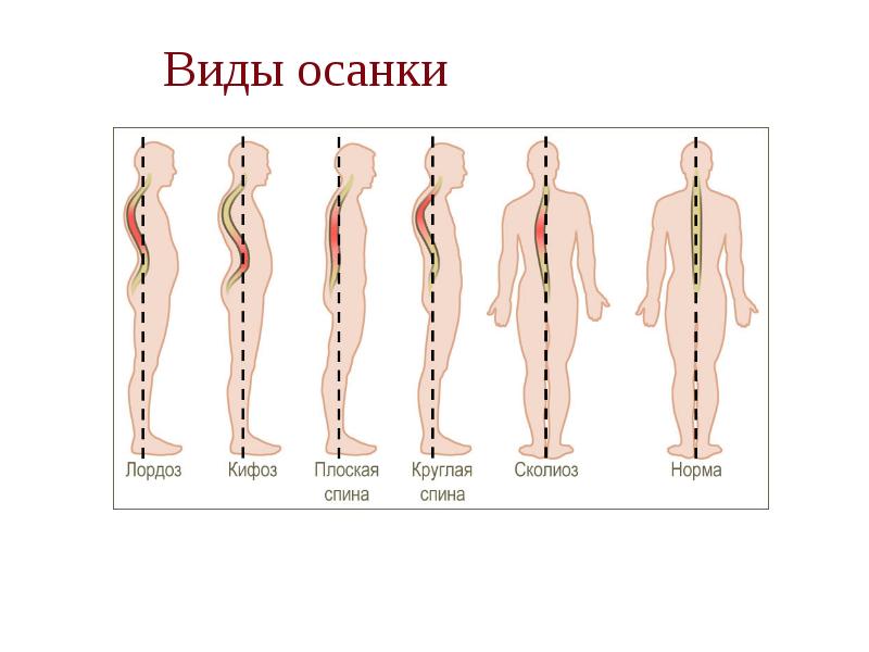 Виды осанки