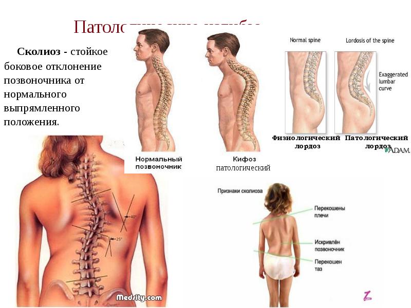 Виды сколиоза позвоночника фото