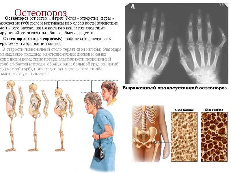 Остеопороз    Остеопороз (от остео…и греч. Póros - отверстие,
