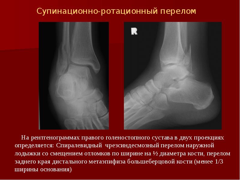 Перелом костей голени карта вызова скорой