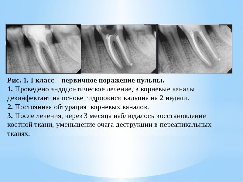 Повторное эндодонтическое лечение презентация