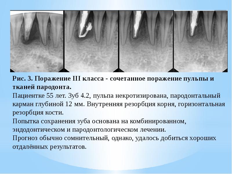 Понятие о пародонтальном комплексе особенности функционирования и биомеханики пародонта презентация