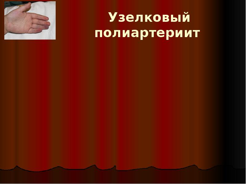 Узелковый полиартериит Узелковый полиартериит