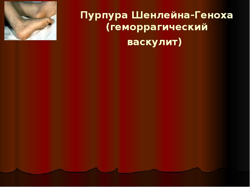 Пурпура Шенлейна-Геноха (геморрагический васкулит) Пурпура Шенлейна-Геноха (геморрагический васкулит)