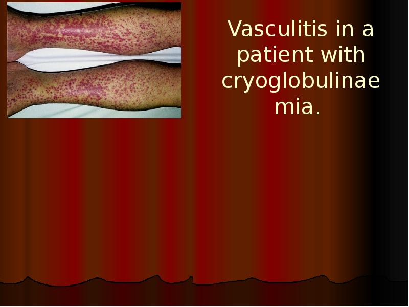 Vasculitis in a patient with cryoglobulinaemia. Vasculitis in a patient with cryoglobulinaemia.
