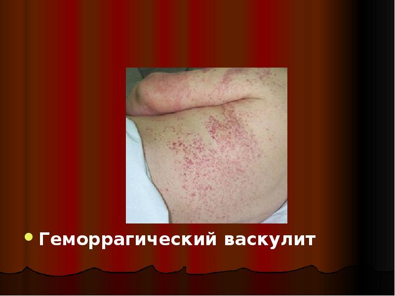 Геморрагический васкулит
Геморрагический васкулит Геморрагический васкулит
Геморрагический васкулит