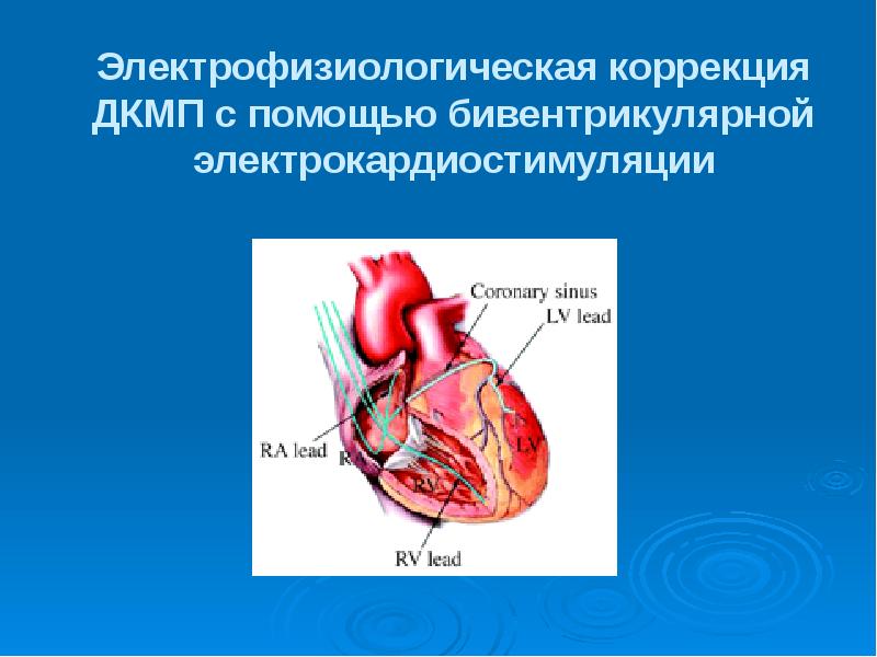 Презентация на тему кардиомиопатии