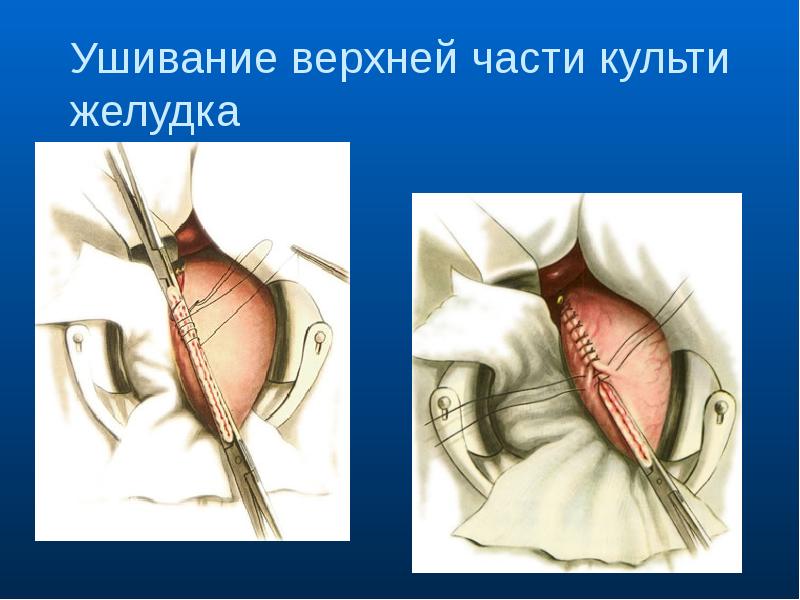 Брюшная полость картинки