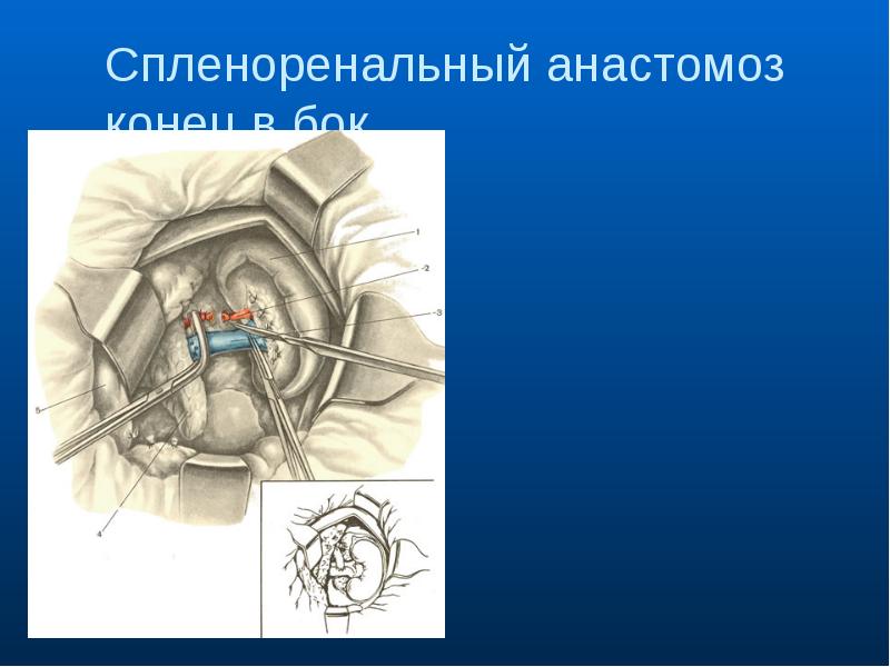 Анастомоз конец в конец схема