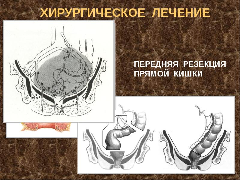 Презентация операции на прямой кишке