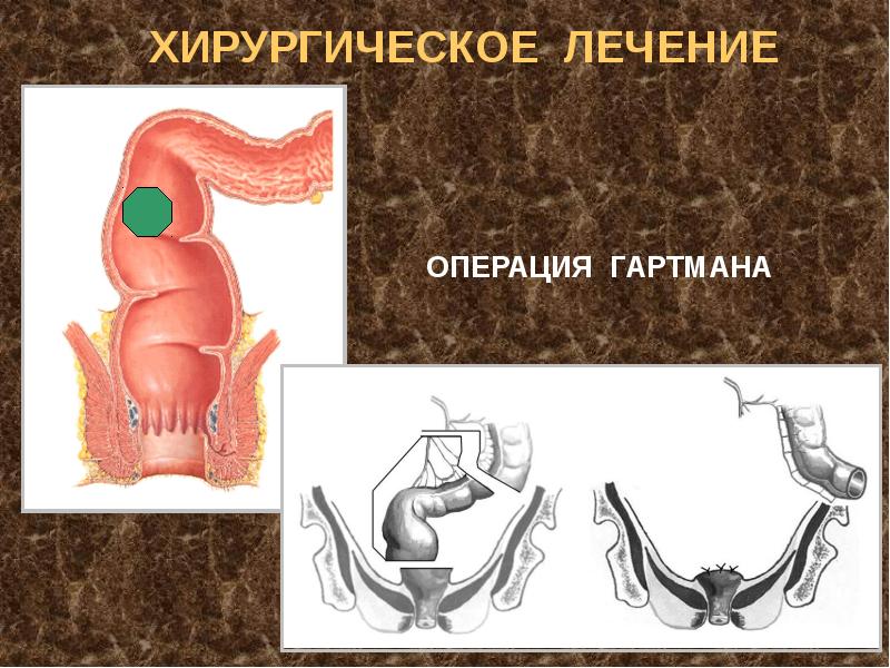 Презентация операции на прямой кишке