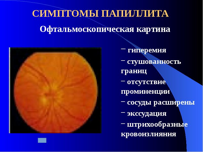 Ретробульбарный неврит презентация