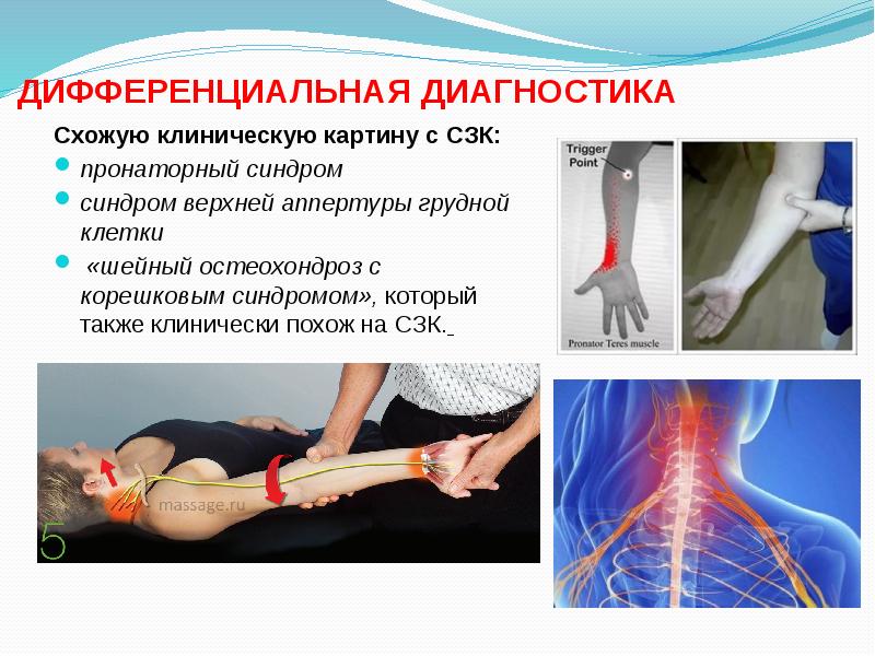 Синдром запястного канала
