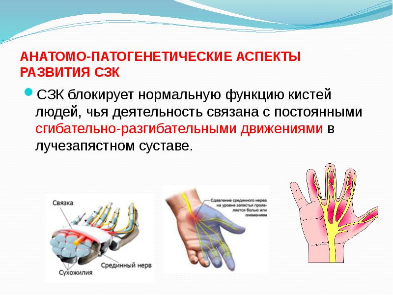 Синдром запястного канала