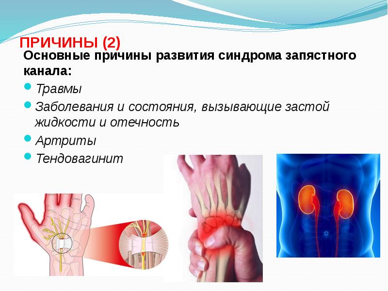 Синдром запястного канала