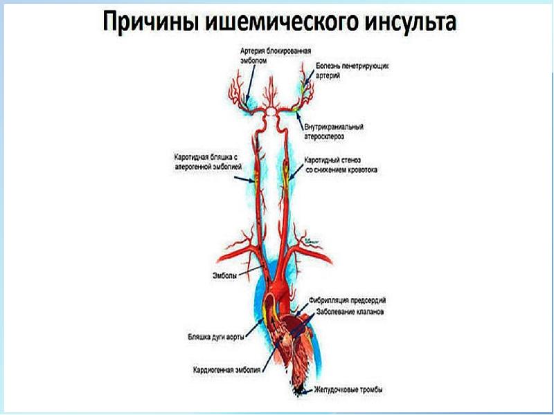 Ишемический инсульт презентация неврология