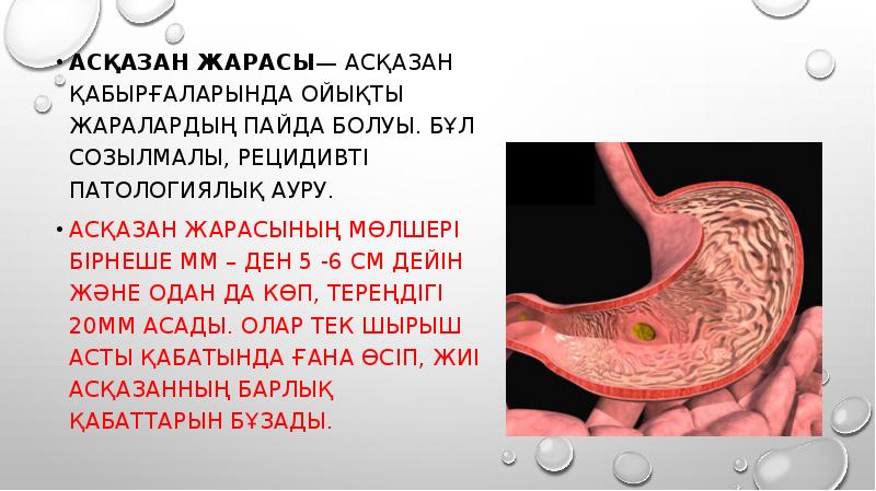 Асқазан обыры презентация