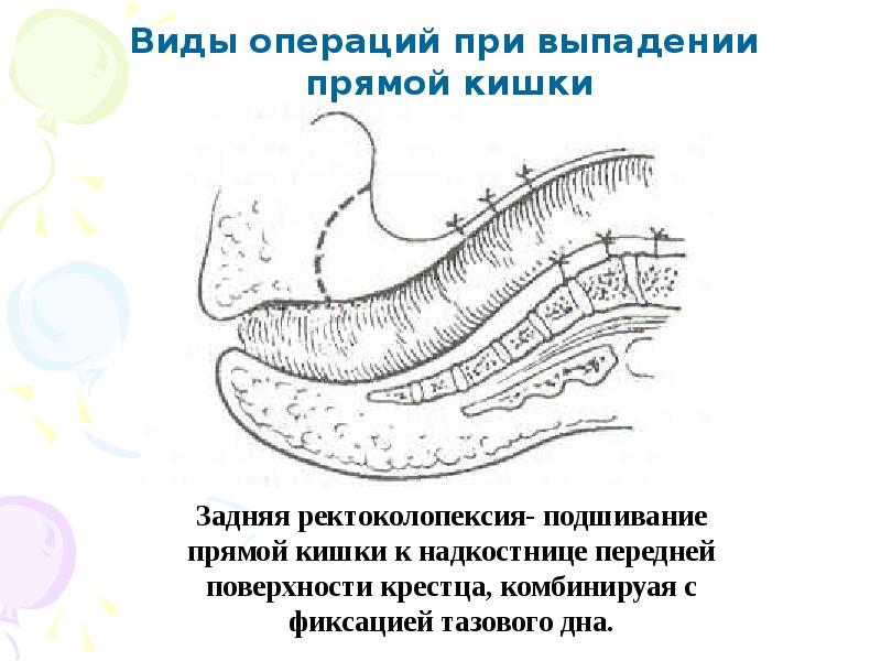 Презентация операции на прямой кишке