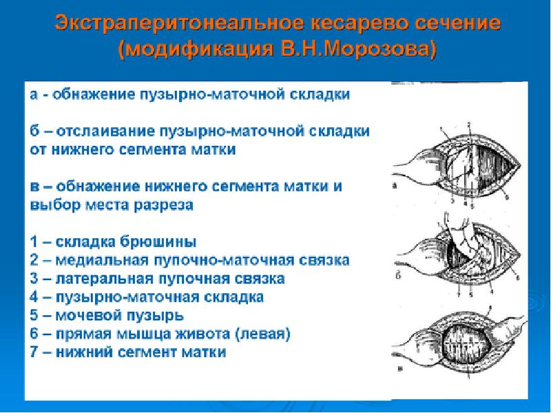 Кесарево в картинках