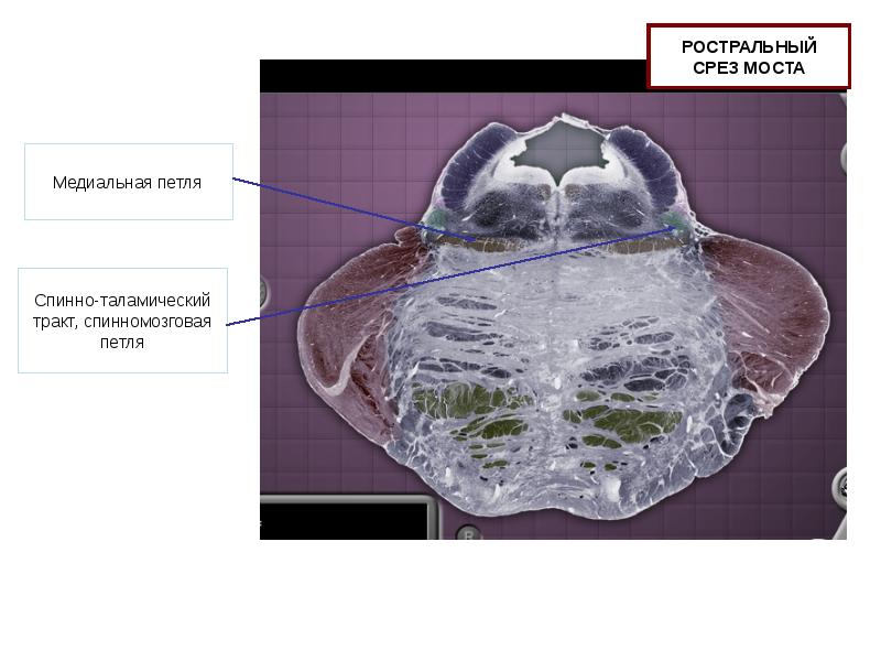 Таламический мост краниопаги.