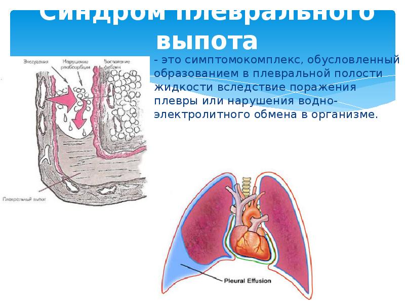 Плевральный выпот это