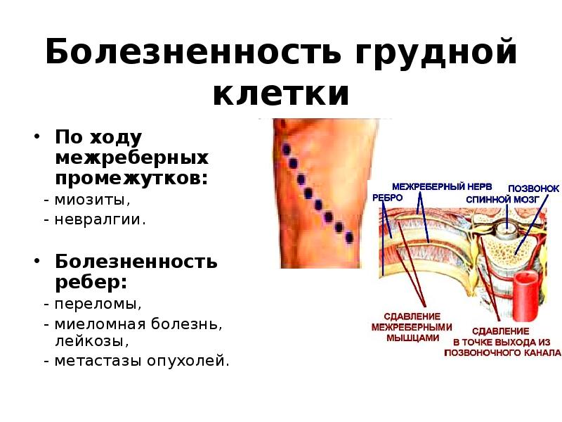 Межреберная невралгия правой стороны симптомы. Меж рёберная невралгия. М Е Ж Р Ё Б Е Р Н А Я Н Е В Р А Л Г И Я. Боли при межреберной невралгии.