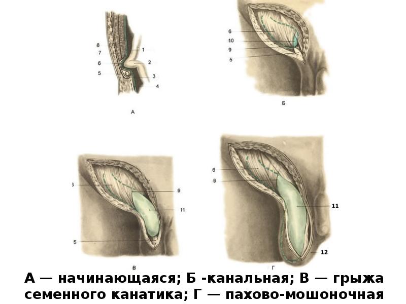 Через какие паховые ямки выходят наружная косая прямая паховые грыжи