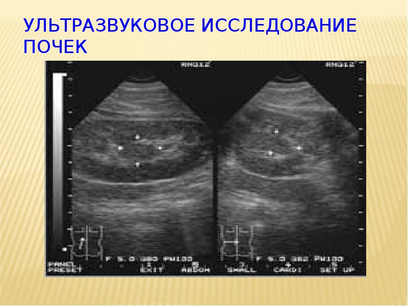 Ультразвуковое исследование почек. Гидрокаликоз почек на УЗИ. Амилоидоз почек на УЗИ. Амилоидоз почек УЗИ картина. УЗИ почек при амилоидозе.