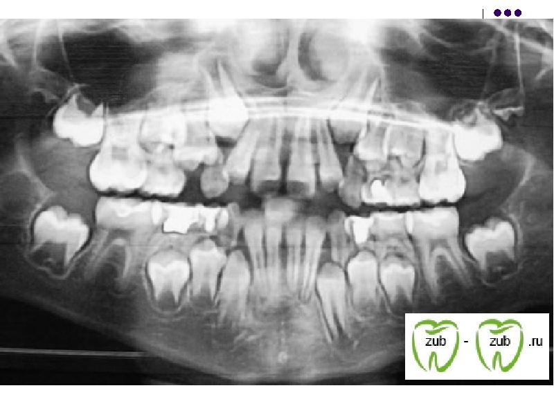 Фото зубов у детей рентген
