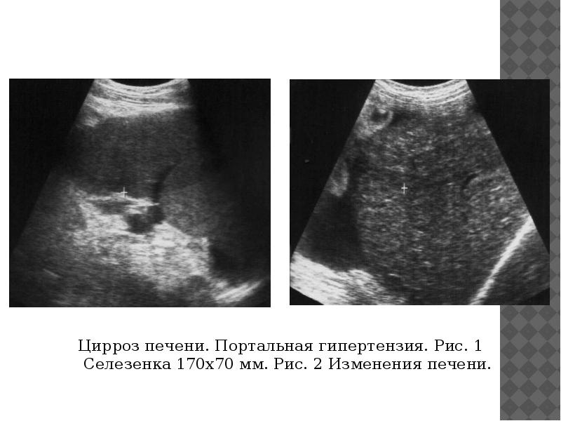 Портальная гипертензия узи картина