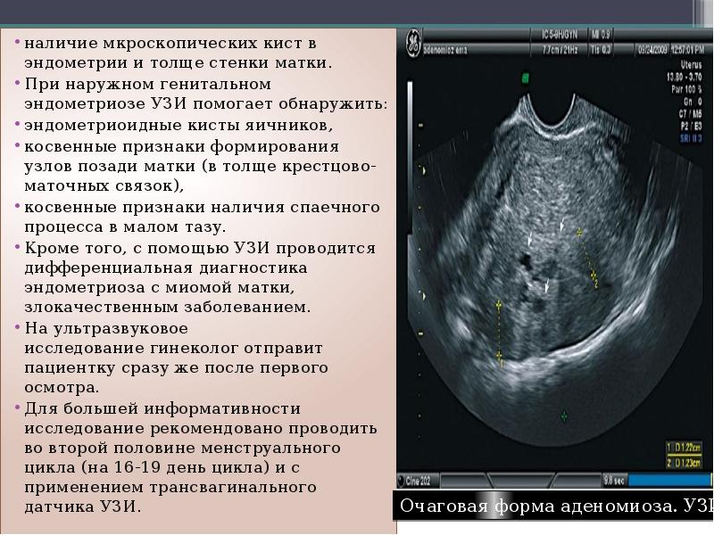 Структурные изменения матки. Эндометриоз яичников на УЗИ. Эндометриома УЗИ картина. Эндометриоидная киста яичника на УЗИ. Эндометриоидные кисты яичников УЗИ.