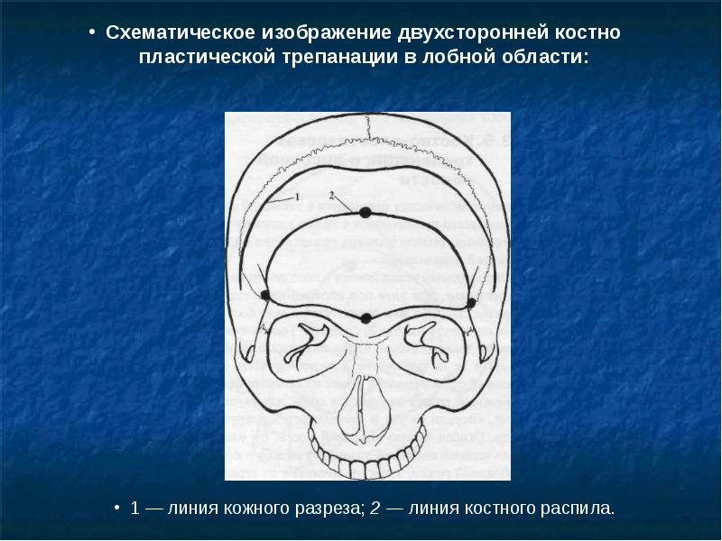 Схема кренлейна черепно мозговая