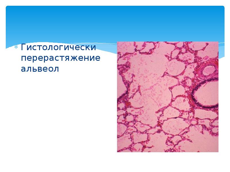 Врожденная лобарная эмфизема у детей презентация