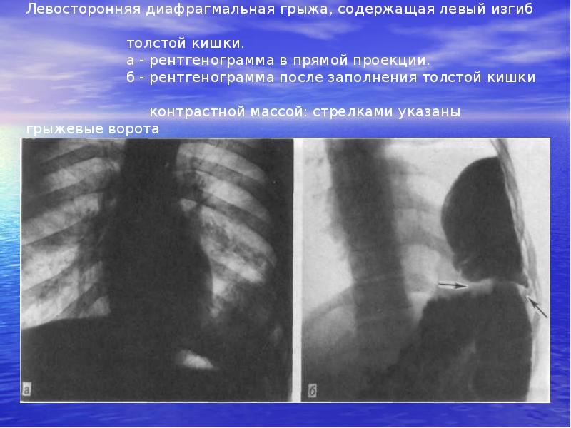 Грыжа бохдалека рентген картина