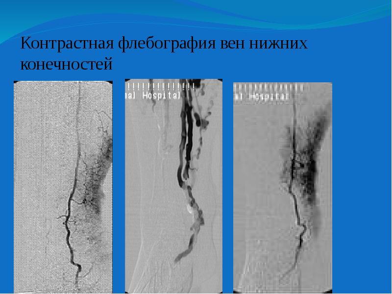 Флебография вен нижних. Кт флебография нижних конечностей. Флебография (венография). Рентгеноконтрастная флебография. Флебография вен нижних конечностей.