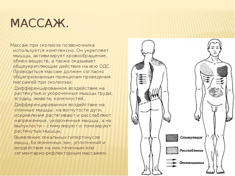 Схема массажа при сколиозе