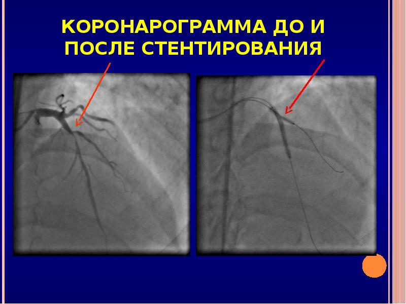 Куда ставят стенты в сердце картинки