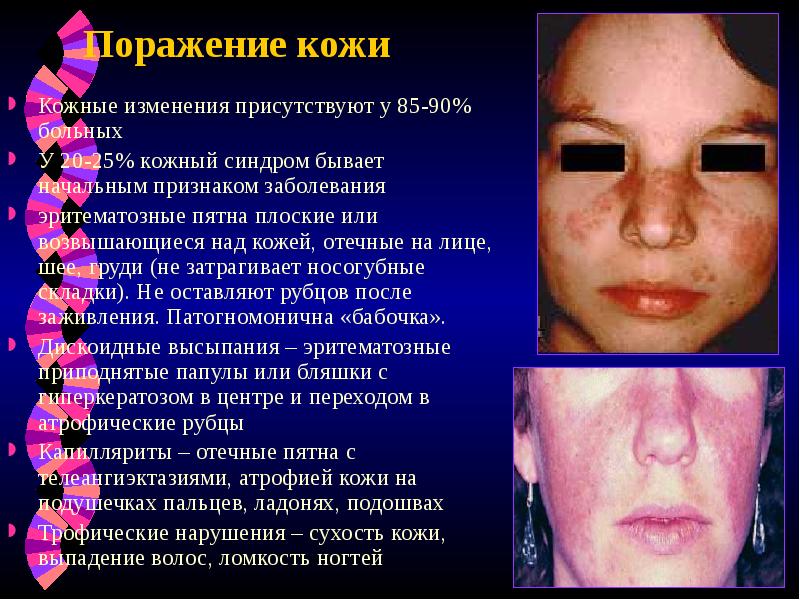 Поражение кожи
Кожные изменения присутствуют у 85-90% больных
У 20-25% кожный Поражение кожи
Кожные изменения присутствуют у 85-90% больных
У 20-25% кожный