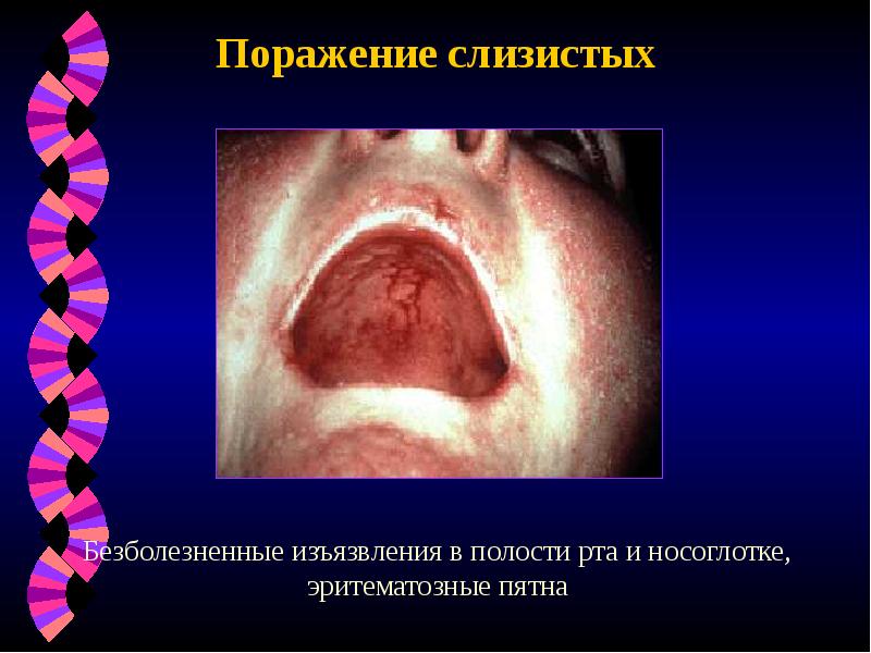 Поражение слизистых Поражение слизистых