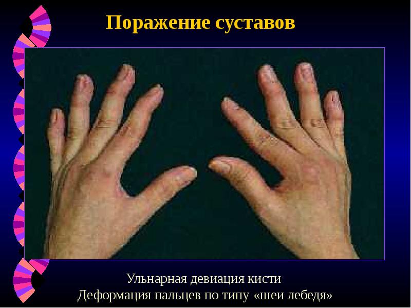 Поражение суставов Поражение суставов