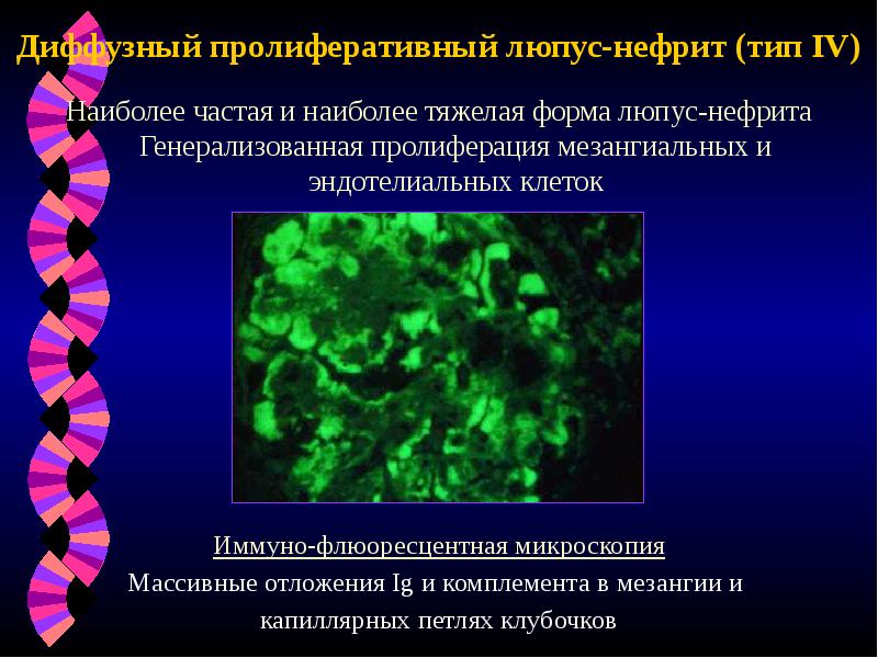 Диффузный пролиферативный люпус-нефрит (тип IV)
Наиболее частая и наиболее тяжелая форма Диффузный пролиферативный люпус-нефрит (тип IV)
Наиболее частая и наиболее тяжелая форма