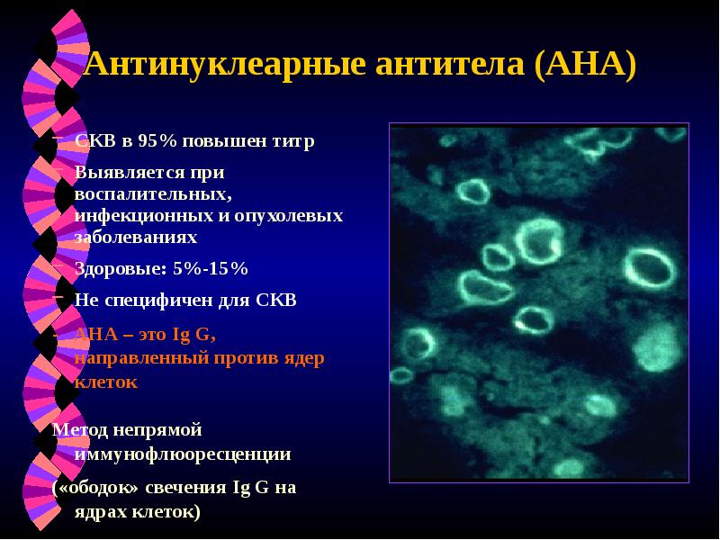 Антинуклеарные антитела (АНА)
СКВ в 95% повышен титр
Выявляется при воспалительных, Антинуклеарные антитела (АНА)
СКВ в 95% повышен титр
Выявляется при воспалительных,