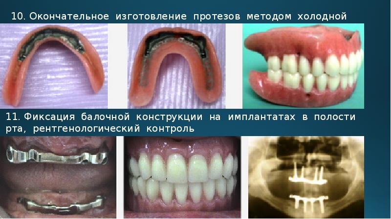 Презентация протезирование на имплантах