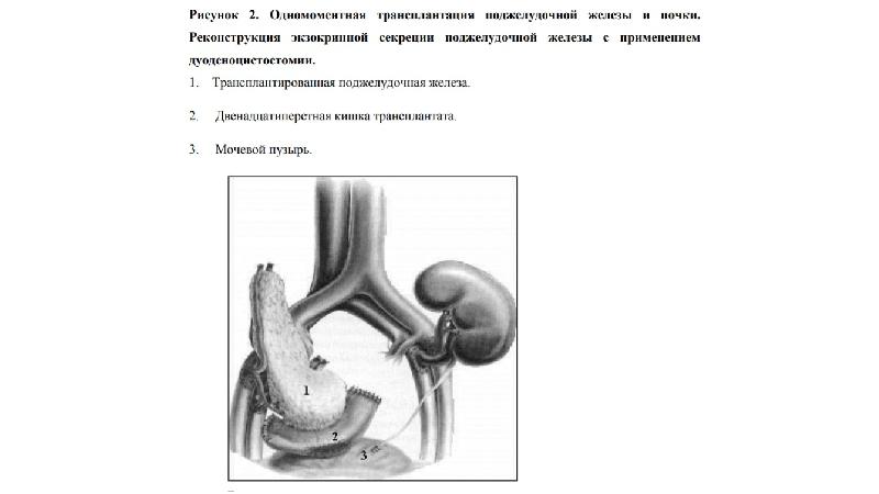 Трансплантация поджелудочной железы презентация