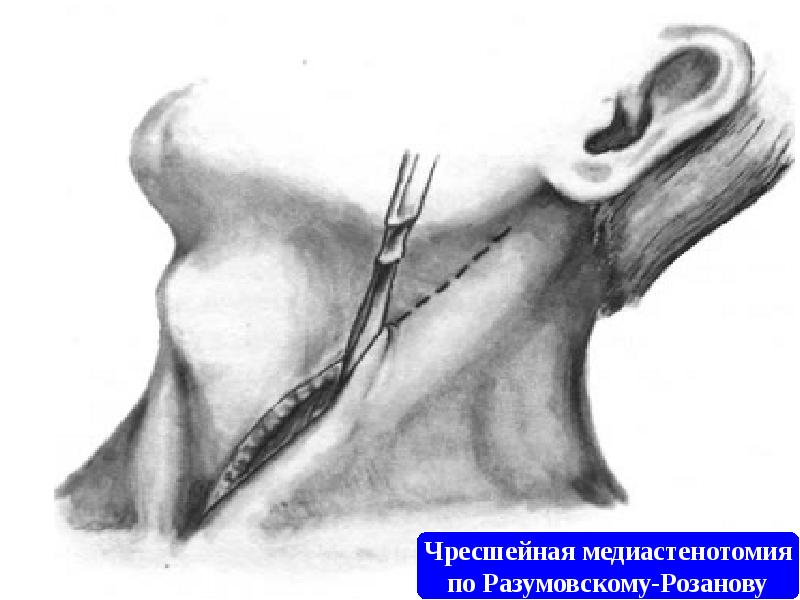 Хирургические заболевания пищевода презентация